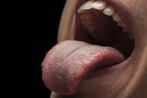 ¿Qué significa tener un grano en la lengua? Descubre sus causas y cómo tratarlo